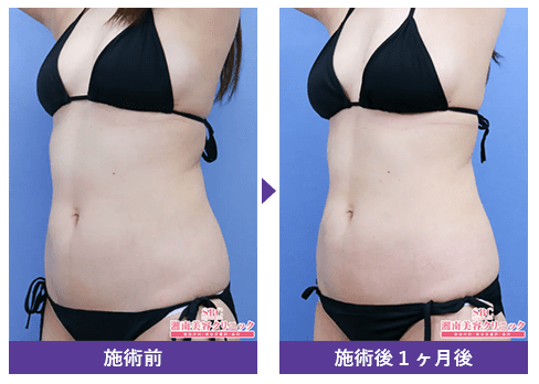 湘南美容外科、GLP-1ダイエットの症例写真